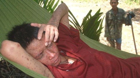 Pham Van Trach, 16, suffering from the mysterious skin disease in Reu Hamlet in Quang Ngai Province (Photo: Tuoi Tre)